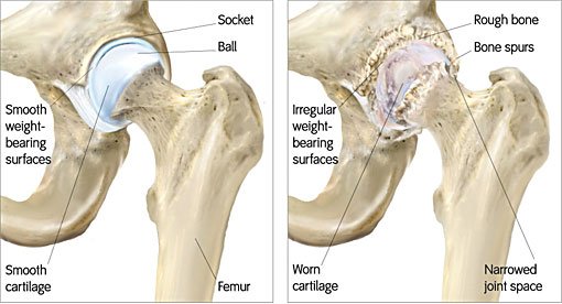 hip resurfacing surgery