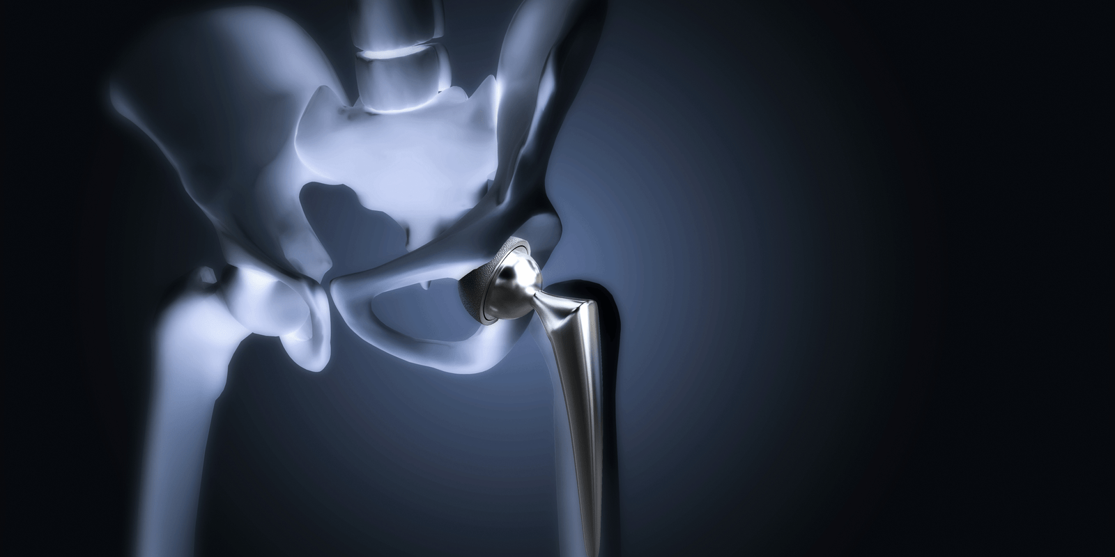 Hip Replacement with DAA in India