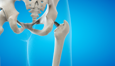 Hip Replacement Surgery Cost in India