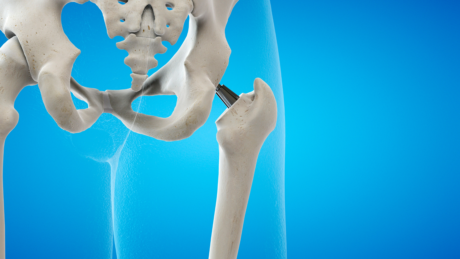 Hip Replacement Surgery Cost in India