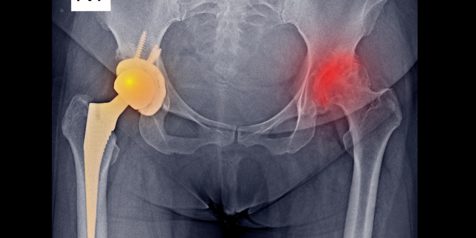 Hip Replacement Surgery in India